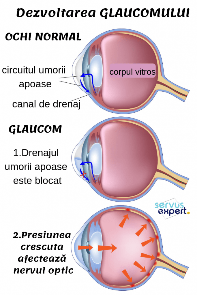 glaucom: cauza de orbire