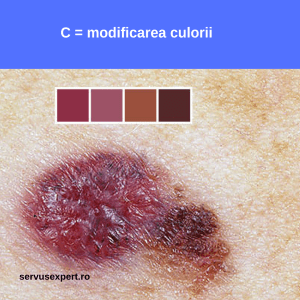 cancer de piele (melanom malign): semne