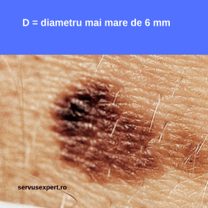 cancer de piele (melanom malign): semne