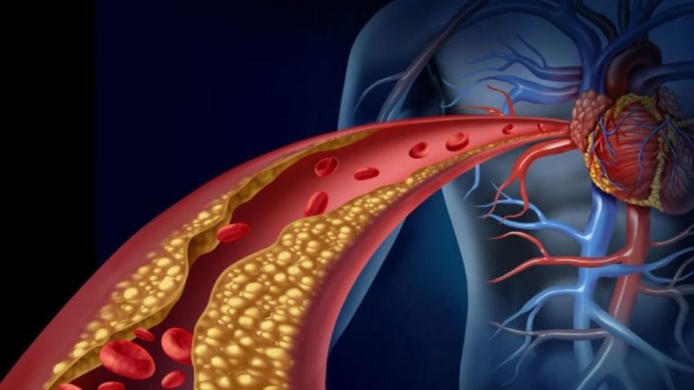 Dislipidemie: cât de scăzut să fie colesterolul ca să nu fii în zona de risc