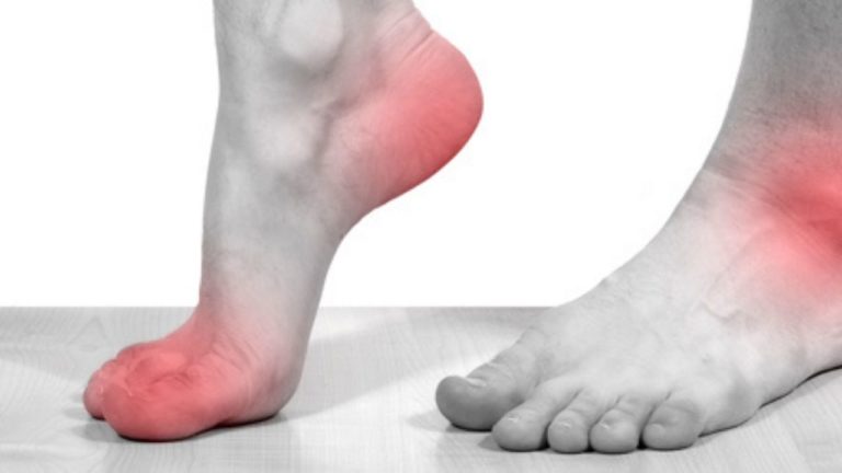 Neuropatia diabetică: simptome, analize, tratament