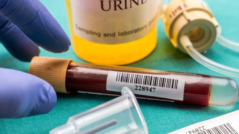 Urina cu sânge (hematuria): ce afecțiuni semnalează?