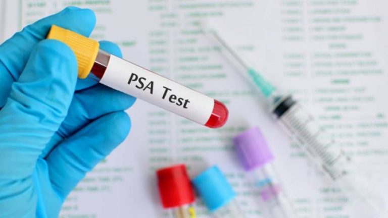 Analiza PSA pentru prostată. Cum să înțelegi rezultatul?