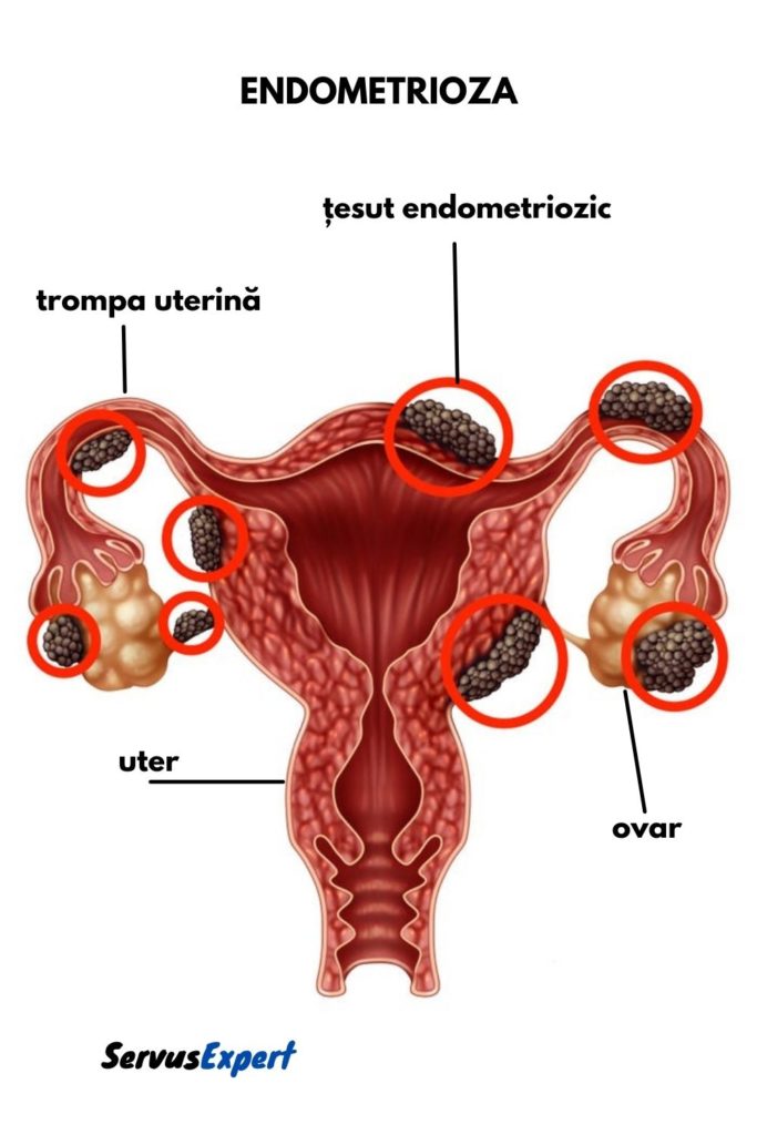 endometrioza simptome
