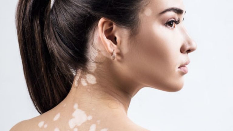 Ruxolitinib – tratament pentru repigmentarea pielii în vitiligo