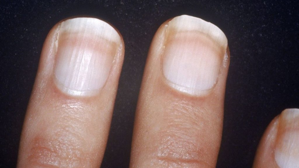 unghiile albicioase