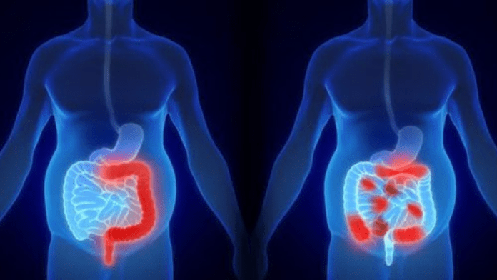 boala Crohn vs colita ulcerativa
