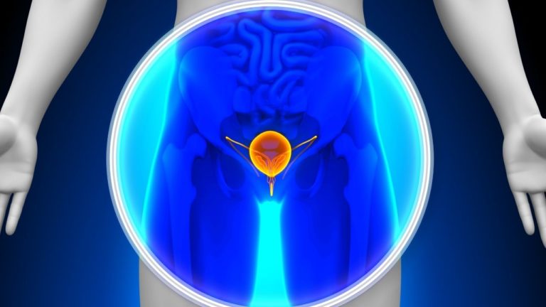 Cancer la vezica urinara: Tratament