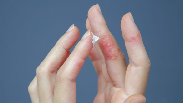 Reușita tratamentului în dermatita atopică