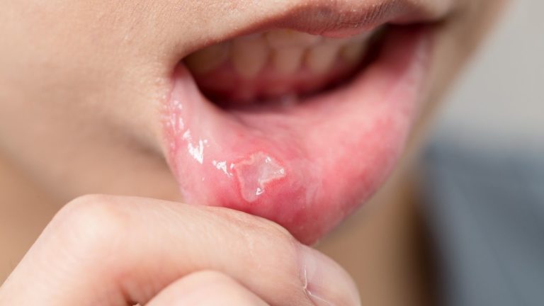 Afte bucale: cum scapi de ele?