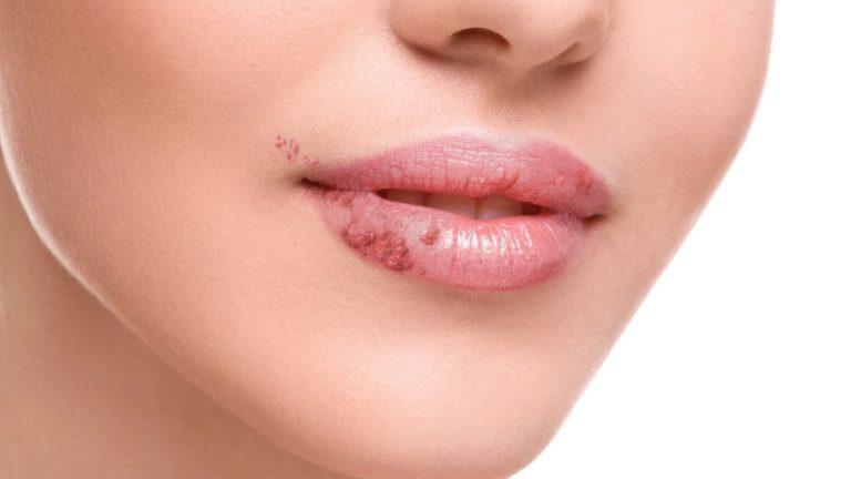 Herpes oral: transmitere, tratament, prevenire