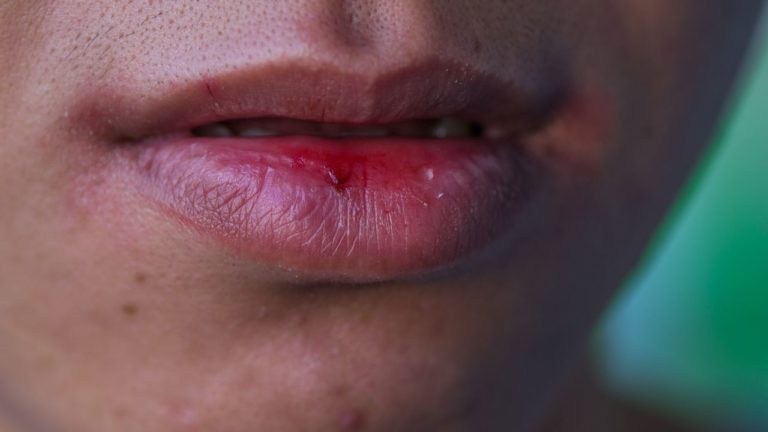 Gura uscata si lipsa de saliva: cauze frecvente