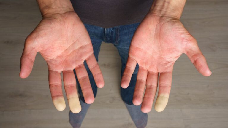 Sindrom Raynaud. De ce am degete amorțite și reci?