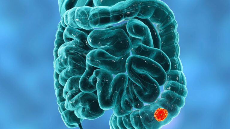 Cancer de colon: simptome care te avertizează