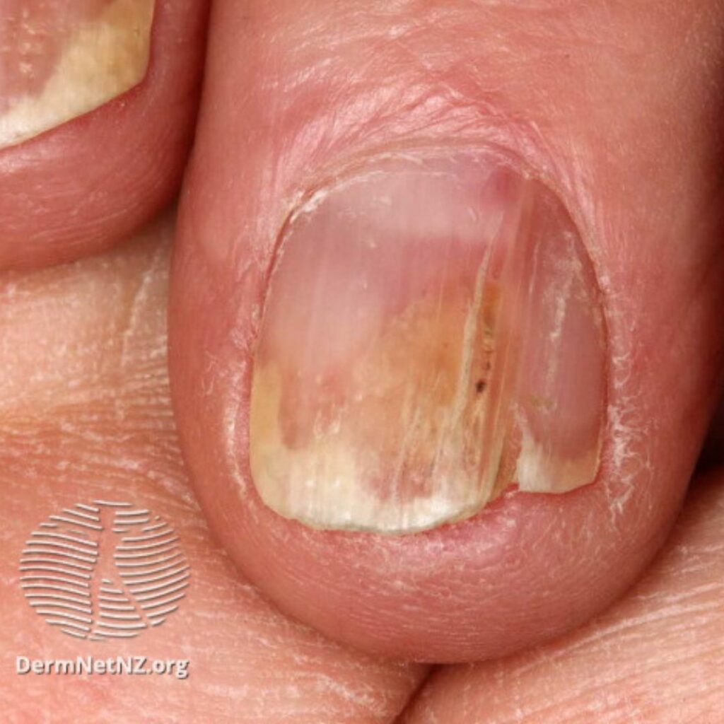 tipuri de psoriazis: psoriazis al unghiilor