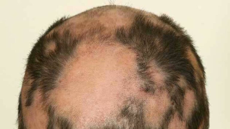 Ce este alopecia areata?