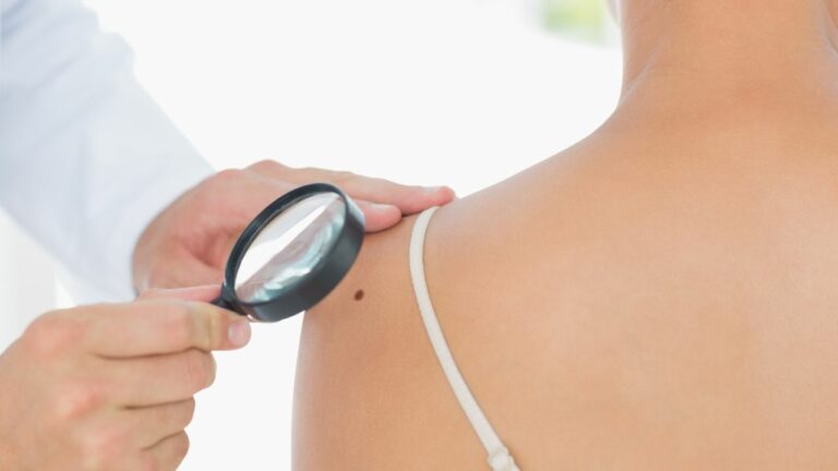 Cancerul de piele: tipuri și semne particulare
