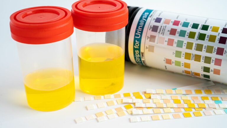 Proteinuria: prezența anormală a proteinelor în urină
