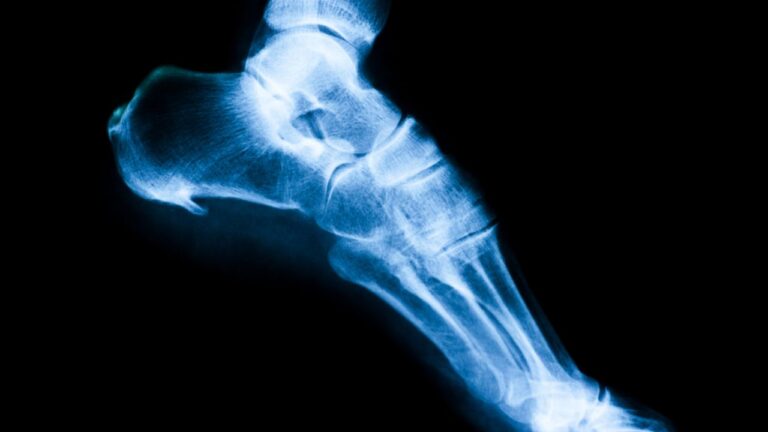 Osteofite (ciocuri osoase): dureri articulare și simptome însoțitoare
