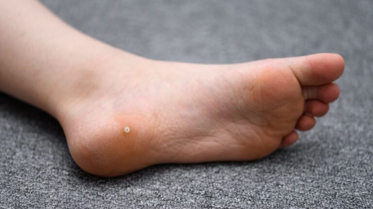 Verucile plantare (negi plantari)