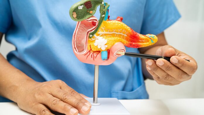 COVER calculi biliari după colecistectomie